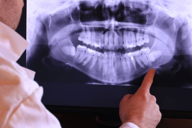 Best Emergency Wisdom Tooth Extraction in San Augustine, TX